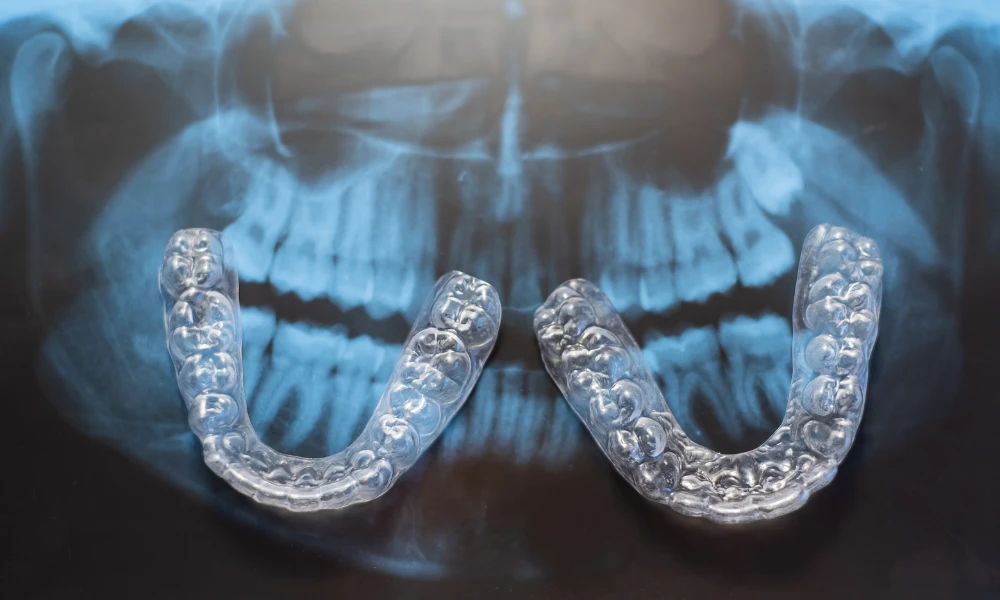 clear dental nightguards displayed in front of a panoramic dental x ray image